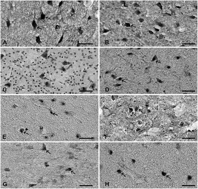 The Stereological Analysis and Spatial Distribution of Neurons in the Human Subthalamic Nucleus